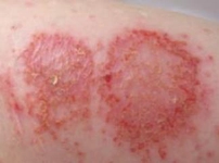 Numuler Dermatit Belirtileri ve Tedavisi